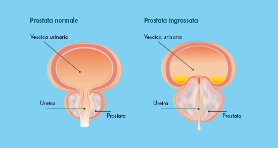 prostatita limfomiozotică dimensiunile prostatitei